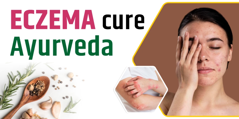 Eczema Cure Ayurveda